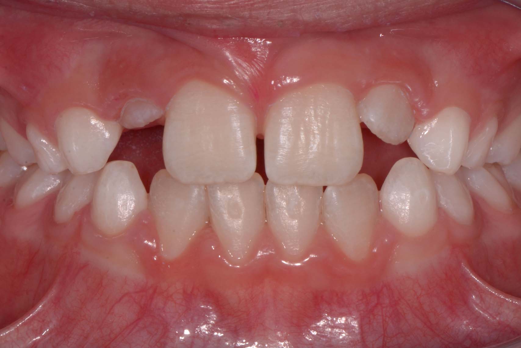 Strahlend weisse Zähne nach professioneller Zahnreinigung durch Prophylaxeassistentin/Dentalhygienikerin